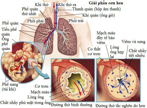 hen phế quản là gì