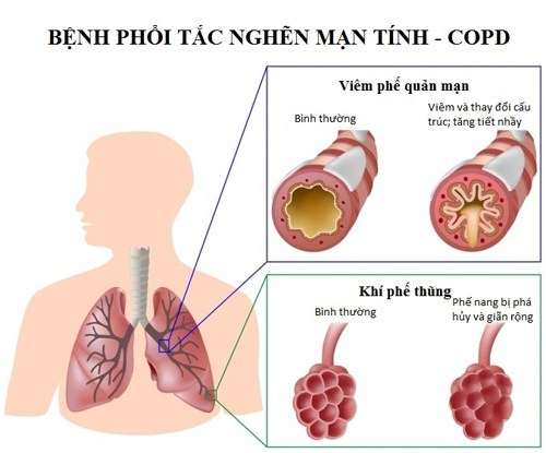 triệu chứng khi mắc copd