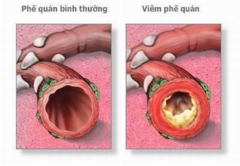 Dấu hiệu nhận biết viêm phế quản