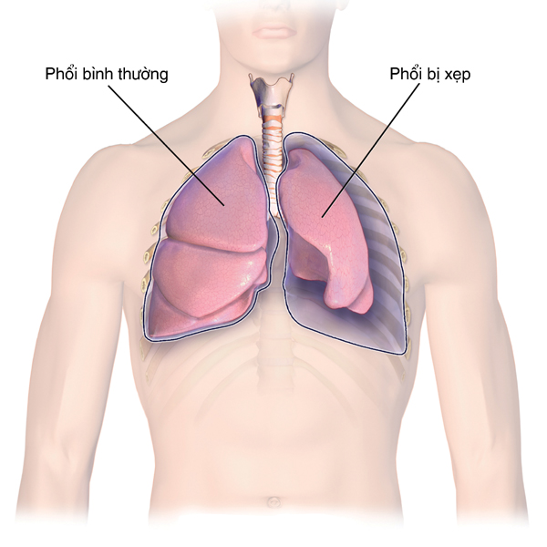 hen phế quản bội nhiễm