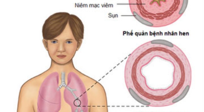 Nội tiết tố ảnh hưởng đến hen