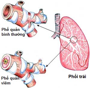 viêm phế quản cấp