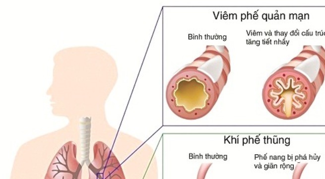 bệnh viêm phế quản mạn tính