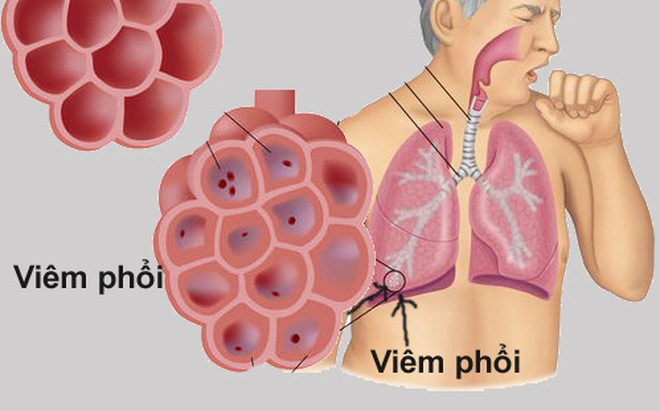 viêm phổi