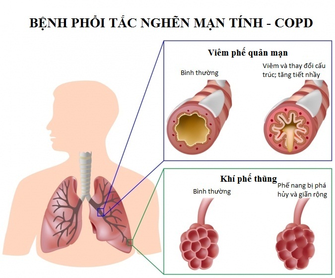 bệnh phổi tắc nghẽn mạn tính copd