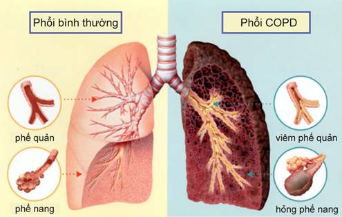 bệnh viêm phổi dễ chết hơn ung thư