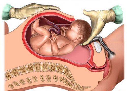 trẻ sinh mỗ dễ mắc những bệnh hen suyễn