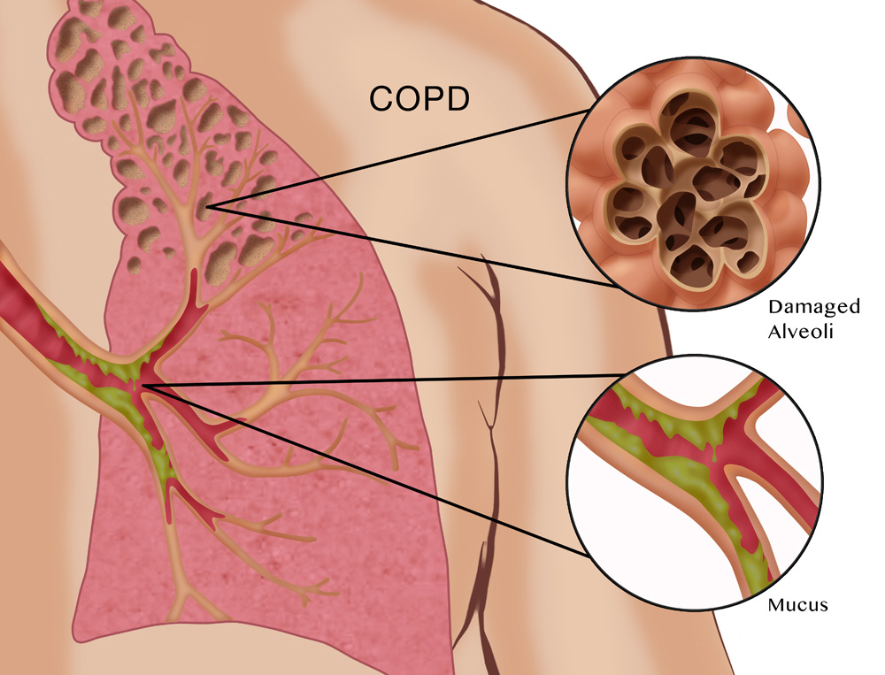 táo bón có thể gây nguy hại cho copd