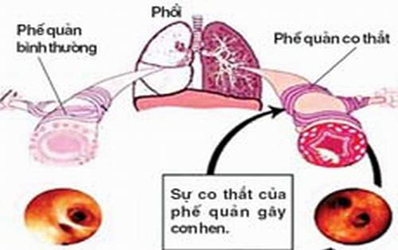 triệu chứng của hen phế quản mãn tính