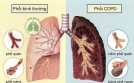 Bệnh phổi tắc nghẽn mạn tính có chữa được không