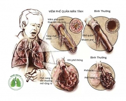 Bài thuốc chữa COPD – Phổi tắc nghẽn mạn tính