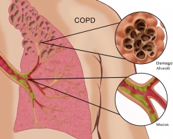 Táo bón có thể gây nguy hiểm cho bệnh nhân COPD