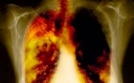 Không khí bẩn, bệnh phổi tăng 10-20 lần
