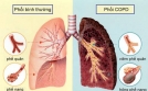 Cảnh báo bệnh phổi tắc nghẽn mạn tính dễ chết hơn ung thư