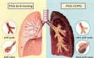 Sự nguy hiểm của bệnh phổi tắc nghẽn mạn tính