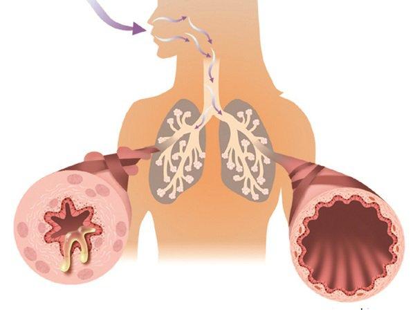 Hen phế quản bội nhiễm là gì, nguyên nhân, triệu chứng và điều trị