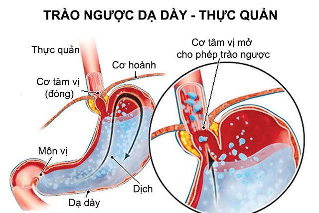 trào ngược dạ dày thực quản